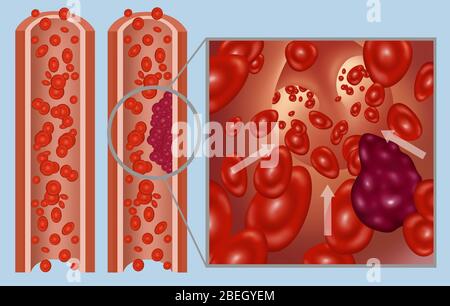 Arterieller Thrombus und Embolus Stockfoto