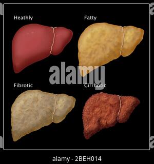 Stadien der Leberschäden Stockfoto