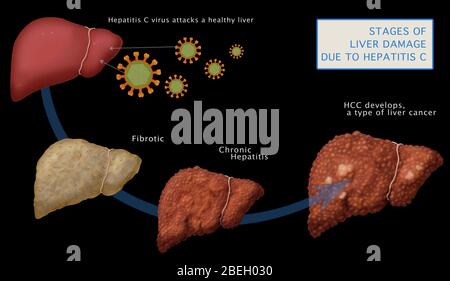 Leberschäden bei Hepatitis C Stockfoto