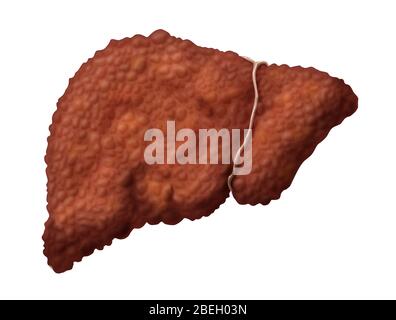 Leberzirrhose Stockfoto
