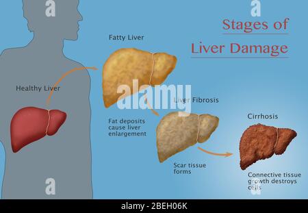 Stadien der Leberschäden Stockfoto
