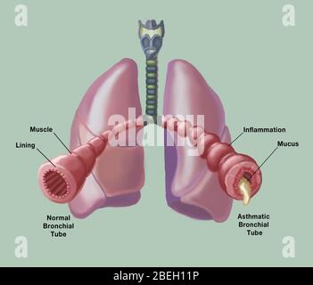 Normale vs. Asthmatische Bronchien Stockfoto