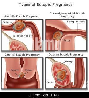 Ektopische Schwangerschaft Stockfoto