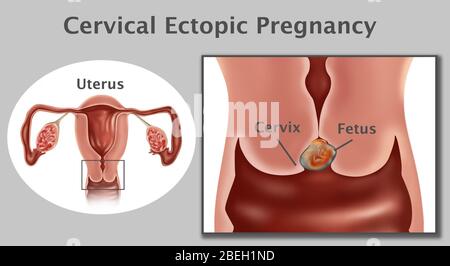 Zervikale Ektopische Schwangerschaft Stockfoto