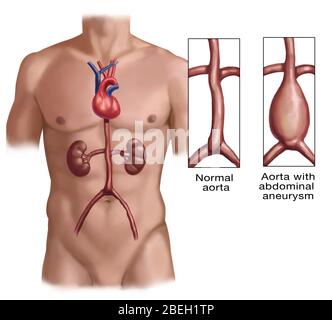 Bauchaneurysma Stockfoto