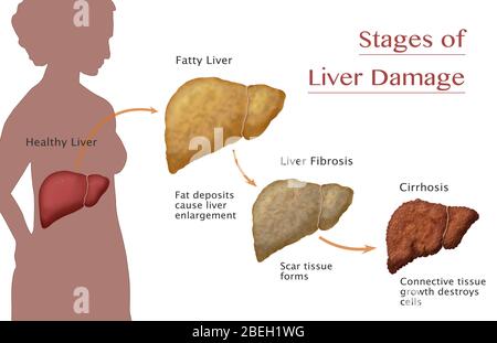 Stadien der Leberschäden Stockfoto