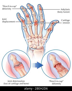 Psoriatische Arthritis, Gelenkanatomie Stockfoto