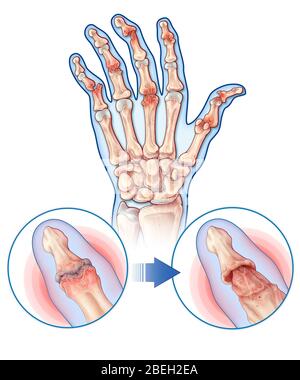 Psoriatische Arthritis, Gelenkanatomie Stockfoto