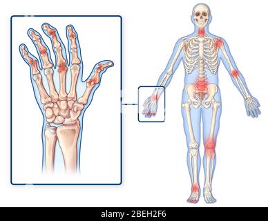 Psoriatische Arthritis, Anatomie Stockfoto