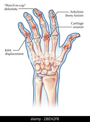 Psoriatische Arthritis, Anatomie Stockfoto