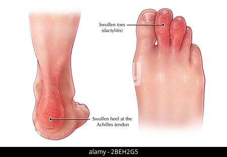 Symptome Der Psoriatischen Arthritis Stockfoto