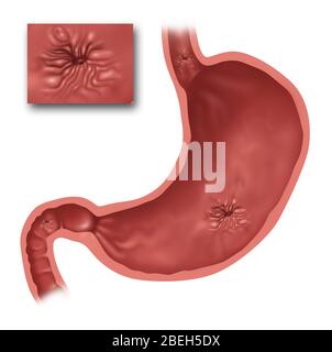 Darstellung des Magens mit mehreren Geschwüren vorhanden. Oben ist die Speiseröhre und darunter ein Ösophagus-Geschwür. Im Magen ist ein Magengeschwür vorhanden, und unten links ist ein Zwölffingerdarmgeschwür im Dünndarm. Inset ist eine Nahaufnahme eines Magengeschwürs. Stockfoto