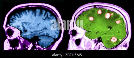 MRT des Gehirns, normal und mit bösartigen Tumoren Stockfoto