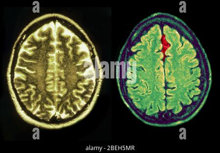 MRT von normalen und verletzten Gehirnen Stockfoto