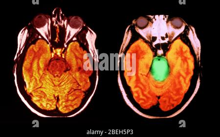 MRT des normalen Gehirns und Hirnstammglioms Stockfoto
