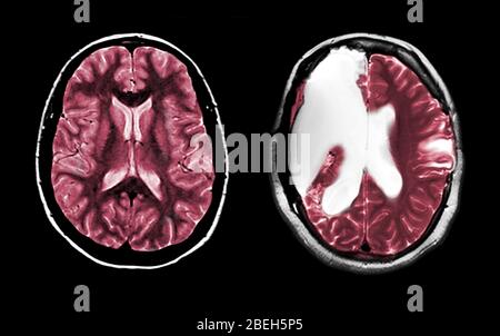 MRT des normalen Gehirns und Hemispherektomie Stockfoto