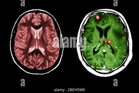 MRT von normalen und tumorgefüllten Gehirnen Stockfoto