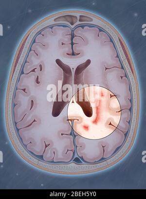 Multiple Sklerose Stockfoto