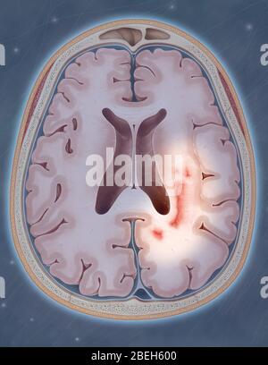 Multiple Sklerose Stockfoto