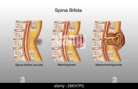 Spina Bifida, Illustration Stockfoto