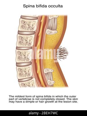 Spina Bifida Occulta, Illustration Stockfoto