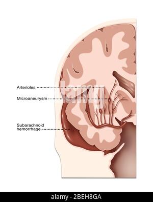 Hämorrhagische Schlaganfallorte, Illustration Stockfoto