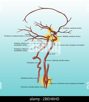 Häufig Blockierte Arterien, Abbildung Stockfoto