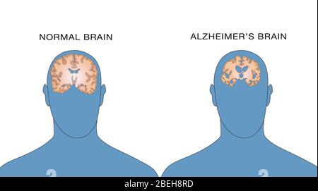 Alzheimer und normale Gehirne, Vergleich Stockfoto