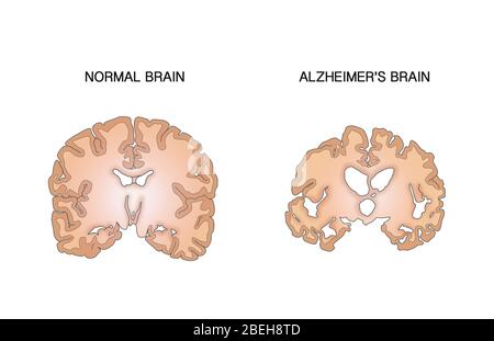 Alzheimer und normale Gehirne, Vergleich Stockfoto