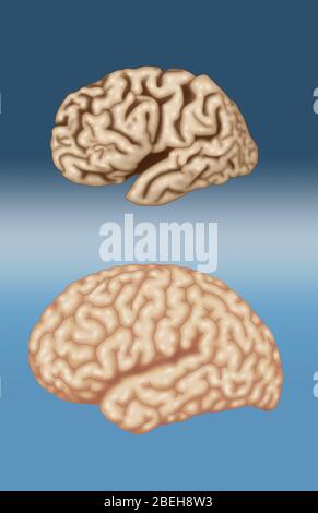 Alzheimer und normale Gehirne, Vergleich Stockfoto