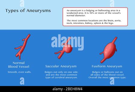 Infografik zum Vergleich eines normalen Blutgefäßes (links) mit zwei Aneurysmarten: Einem sakkulären Aneurysma (Mitte), der am häufigsten vorkommende Typ des zerebralen Aneurysmas, bei dem das Blutgefäß nur auf einer Seite auswölbt; Und ein fusiforme Aneurysma (rechts), die häufigste allgemeine Art, wo das Blutgefäß auswölbt auf allen Seiten. Stockfoto