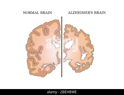 Alzheimer und normale Gehirne, Vergleich Stockfoto