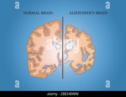 Alzheimer und normale Gehirne, Vergleich Stockfoto