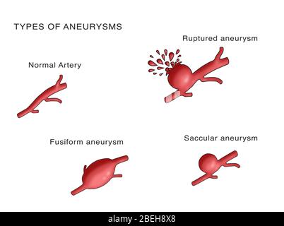 Arten von Aneurysmen Stockfoto