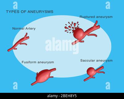 Arten von Aneurysmen Stockfoto