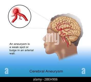 Gehirn Aneurysma in situ Stockfoto