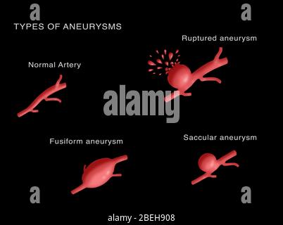 Arten von Aneurysmen Stockfoto