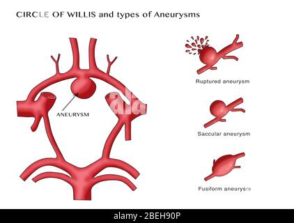 Aneurysma im Kreis von Willis Stockfoto