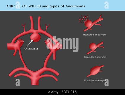 Aneurysma im Kreis von Willis Stockfoto