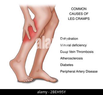 Beinkrampf Häufige Ursachen, Illustration Stockfoto