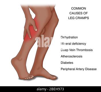 Beinkrampf Häufige Ursachen, Illustration Stockfoto