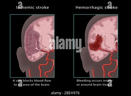 Ischämischer Und Hämorrhagischer Schlaganfall, Illustration Stockfoto