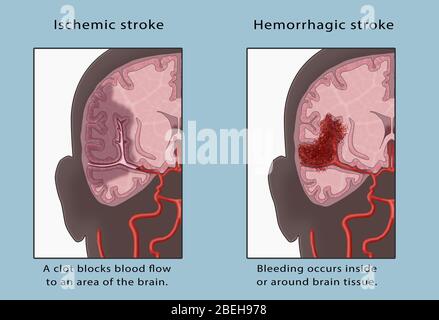 Ischämischer Und Hämorrhagischer Schlaganfall, Illustration Stockfoto