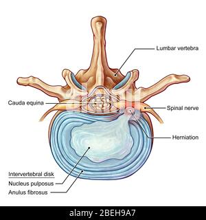 Eine Illustration eines posterolateralen Herniations einer Bandscheibe in der Lendenwirbelsäule. Personen leiden an einem Bandscheibenvorfällen, wenn das äußere Fasergewebe der Bandscheibe, der als Anulus fibrosus bekannt ist, durch Trauma oder Alter brechen kann. Dadurch ragt das gelartige Zentrum der Scheibe nach außen und komprimiert die Nerven im Rücken, schwächt die Muskeln und verursacht starke lokale Rückenschmerzen. Stockfoto