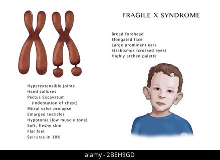 Fragile X-Syndrom Symptome. Abbildung. Stockfoto