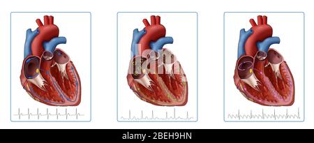 Herz, Afib und Atrial Flutter, Illustration Stockfoto