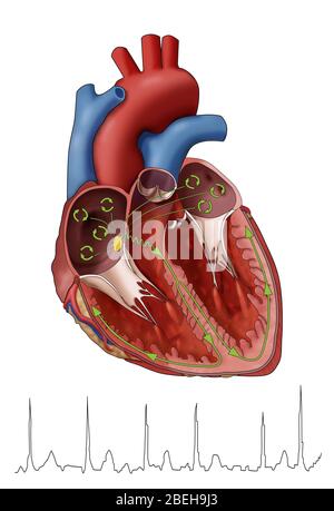 Vorhofflimmern mit EKG, Illustration Stockfoto