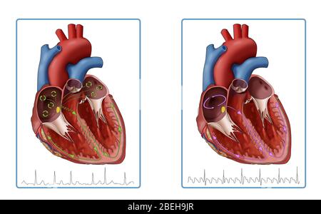 Vorhofflimmern und -flattern, Illustration Stockfoto