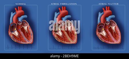 Herz, Afib und Atrial Flutter, Illustration Stockfoto