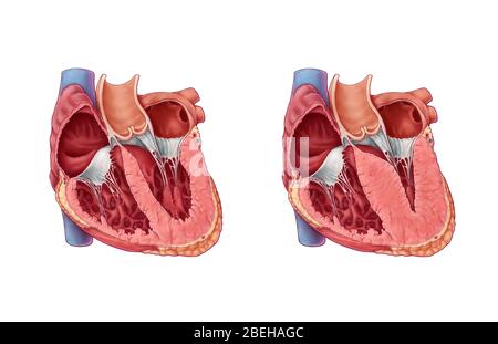 Hypertrophe Kardiomyopathie Stockfoto